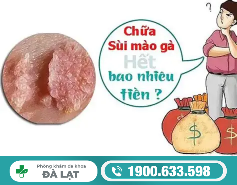 GIẢI ĐÁP CHI TIẾT CHI PHÍ KHÁM CHỮA SÙI MÀO GÀ
